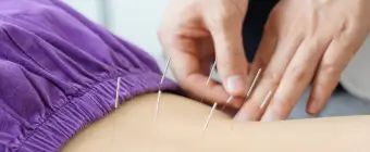 Close-up of a physiotherapist performing professional acupuncture treatment on a patient's shoulder.